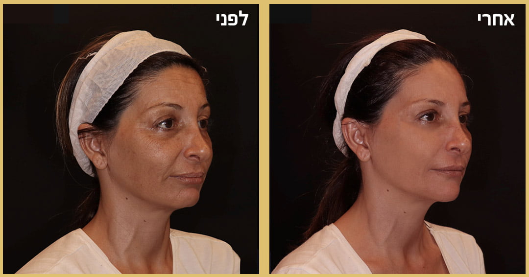 נפילת לחיים