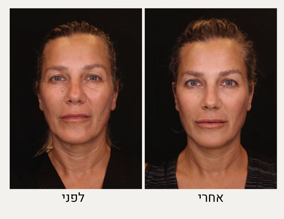 טיפול בפולינוקלאוטידים לפני ואחרי - המרכז לרפואת עור ואסתטיקה, ד"ר אלה אגוזי