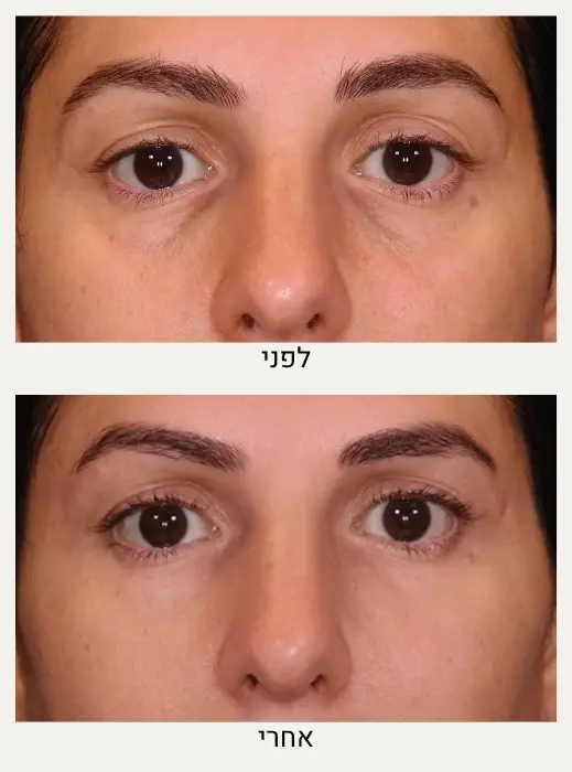 לפני ואחרי טיפול בשקיות מתחת לעיניים - מרכז לרפואת עור ואסתטיקה בהנהלת ד״ר אלה אגוזי
