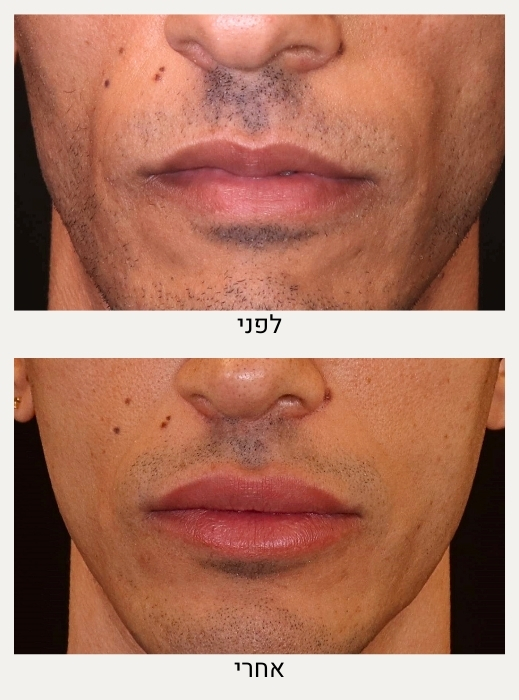 עיצוב שפתיים לגבר לפני ואחרי - ד"ר אלה אגוזי