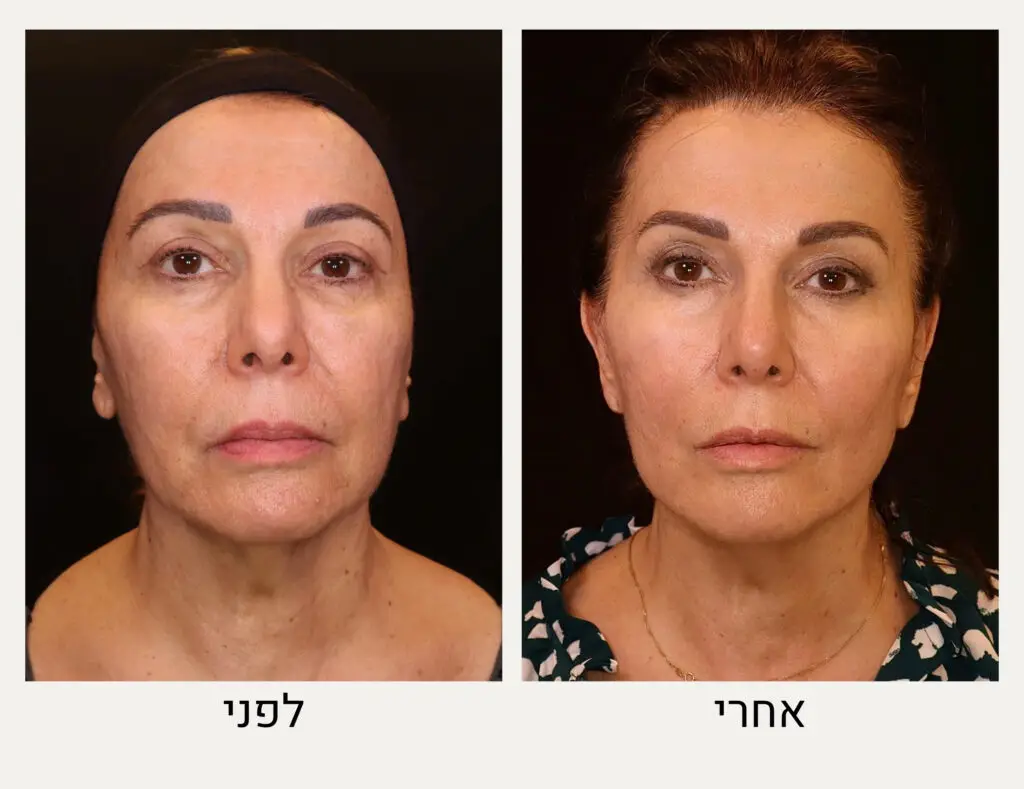 הרמת פנים ללא ניתוח לפני ואחרי - ד״ר אלה אגוזי