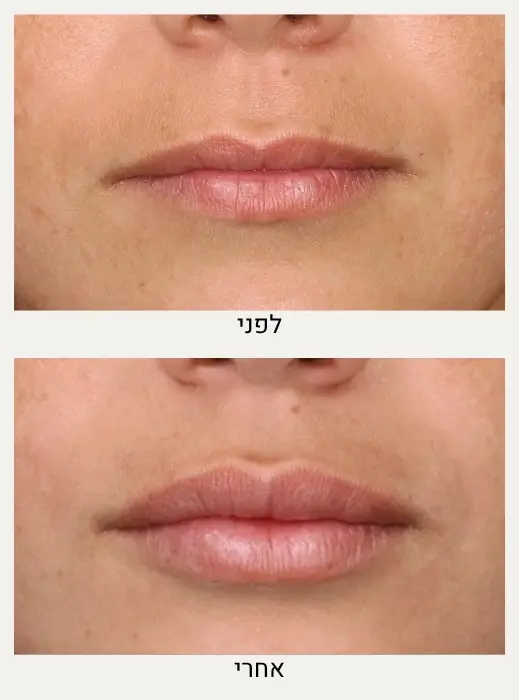 עיבוי שפתיים לפני ואחרי - המרכז לרפואת עור ואסתטיקה, ד״ר אלה אגוזי