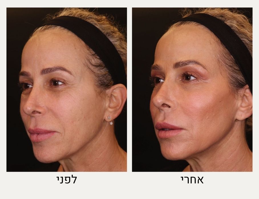 עיצוב עצמות לחיים לפני ואחרי - מרכז לרפואת עור ואסתטיקה בהנהלת ד״ר אלה אגוזי