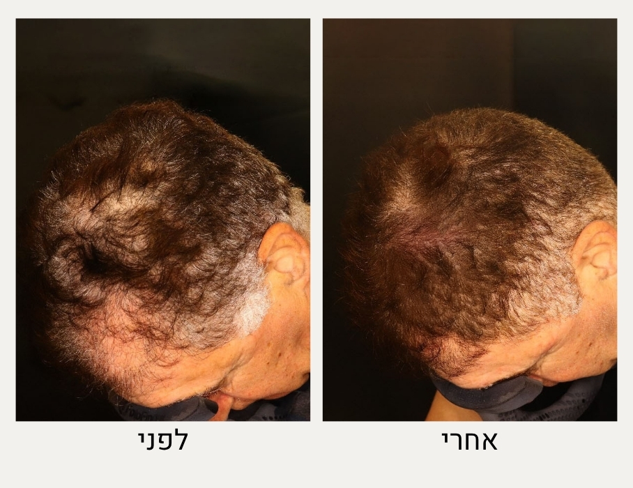 לפני ואחרי טיפול PRP לשיער - ד"ר אלה אגוזי