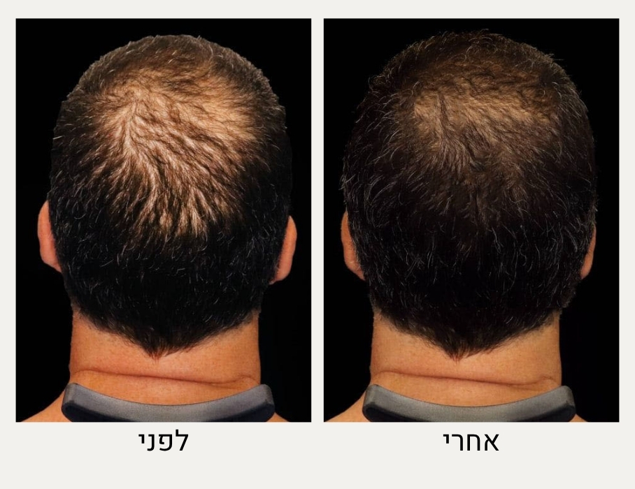 לפני ואחרי טיפול אנטיאז - ד"ר אלה אגוזי