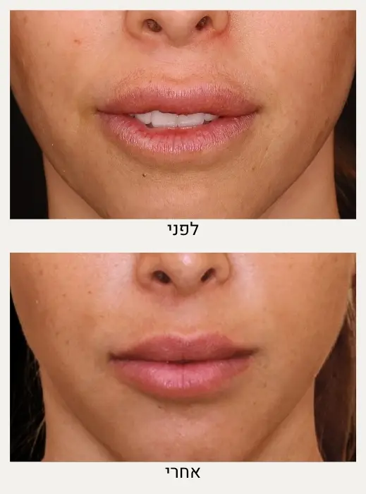 לפני ואחרי המסת חומצה היאלורונית - ד״ר אלה אגוזי