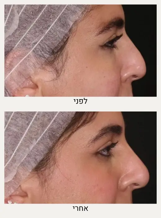 לפני ואחרי פיסול אף ללא ניתוח - מרכז לרפואת עור ואסתטיקה בהנהלת ד״ר אלה אגוזי
