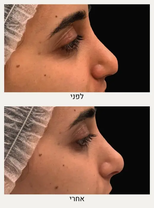 פיסול אף ללא ניתוח לפני ואחרי - ד״ר אלה אגוזי