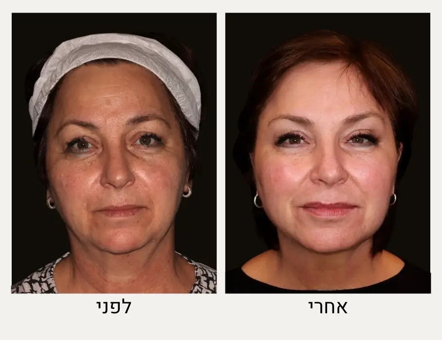 טיפול ביוסטימולטור לפני ואחרי - מרכז לרפואת עור ואסתטיקה בהנהלת ד״ר אלה אגוזי