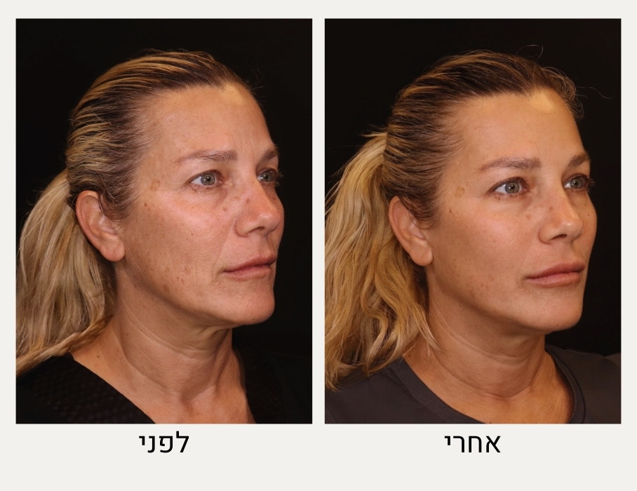 טיפול רדיאס לפני ואחרי - ד"ר אלה אגוזי