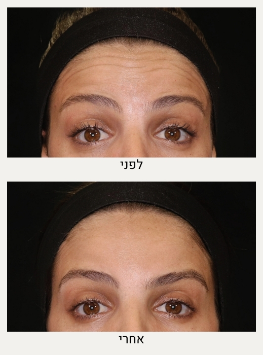 סרטון - הרמת פנים, ד״ר אלה אגוזי