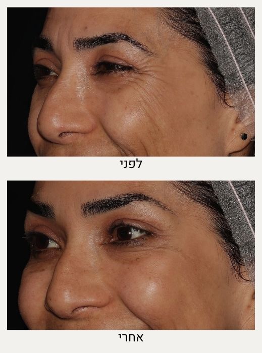 בוטוקס בצידי העיניים לפני ואחרי - ד"ר אלה אגוזי