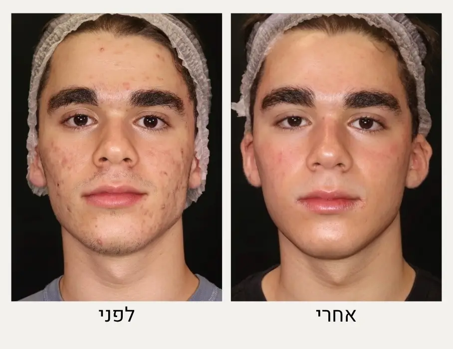 לפני ואחרי טיפול באקנה בפנים - המרכז לרפואת עור ואסתטיקה בהנהלת ד"ר אלה אגוזי