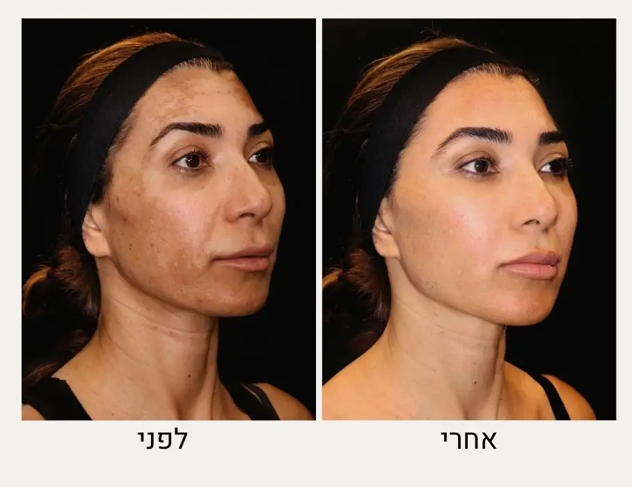 הסרת פיגמנטציה בלייזר לפני ואחרי - ד״ר אלה אגוזי