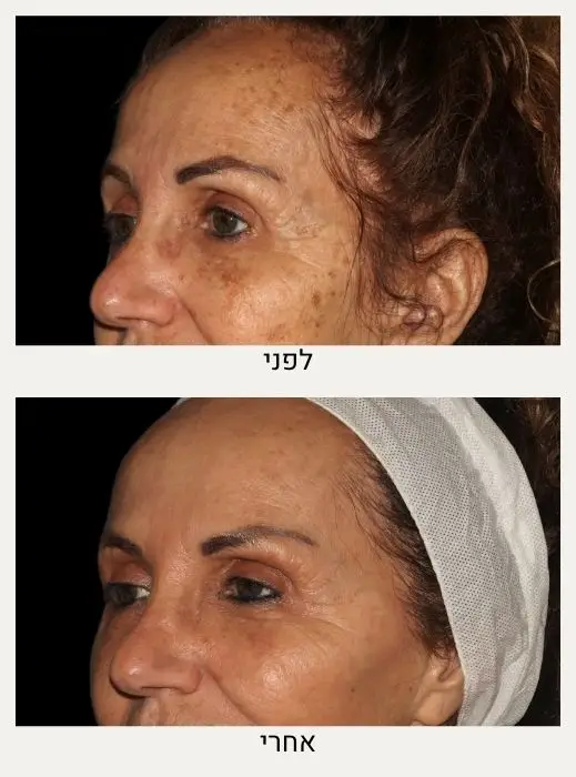 טיפול בפיגמנטציה בפנים לפני ואחרי - המרכז לרפואת עור ואסתטיקה בהנהלת ד"ר אלה אגוזי