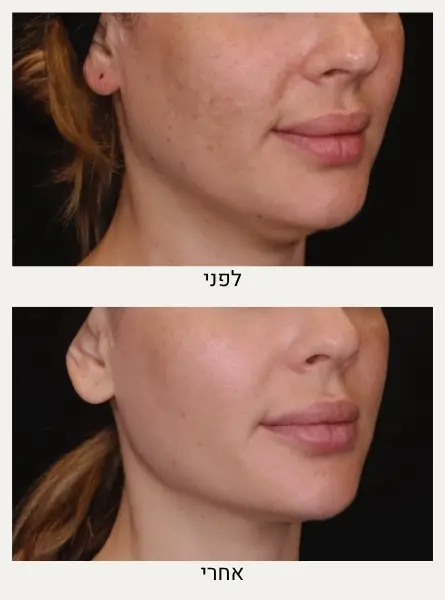 טיפול מזותרפיה לפנים לפני ואחרי - המרכז לרפואת עור ואסתטיקה בהנהלת ד"ר אלה אגוזי
