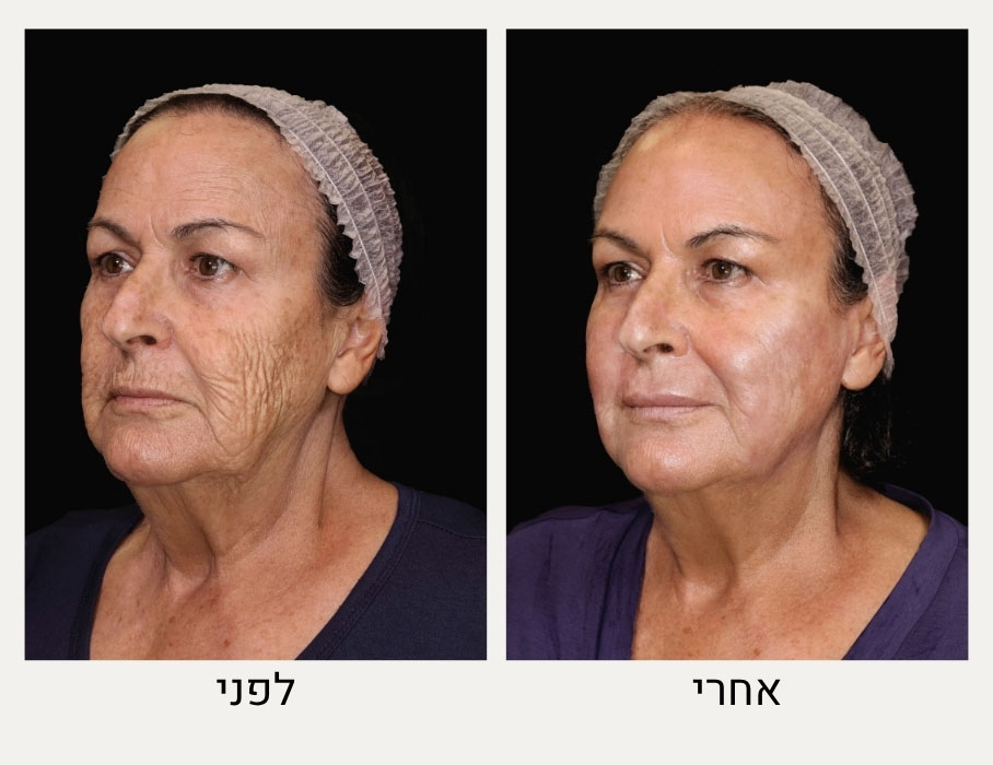 פילינג כימי לפנים לפני ואחרי - המרכז לרפואת עור ואסתטיקה בהנהלת ד"ר אלה אגוזי