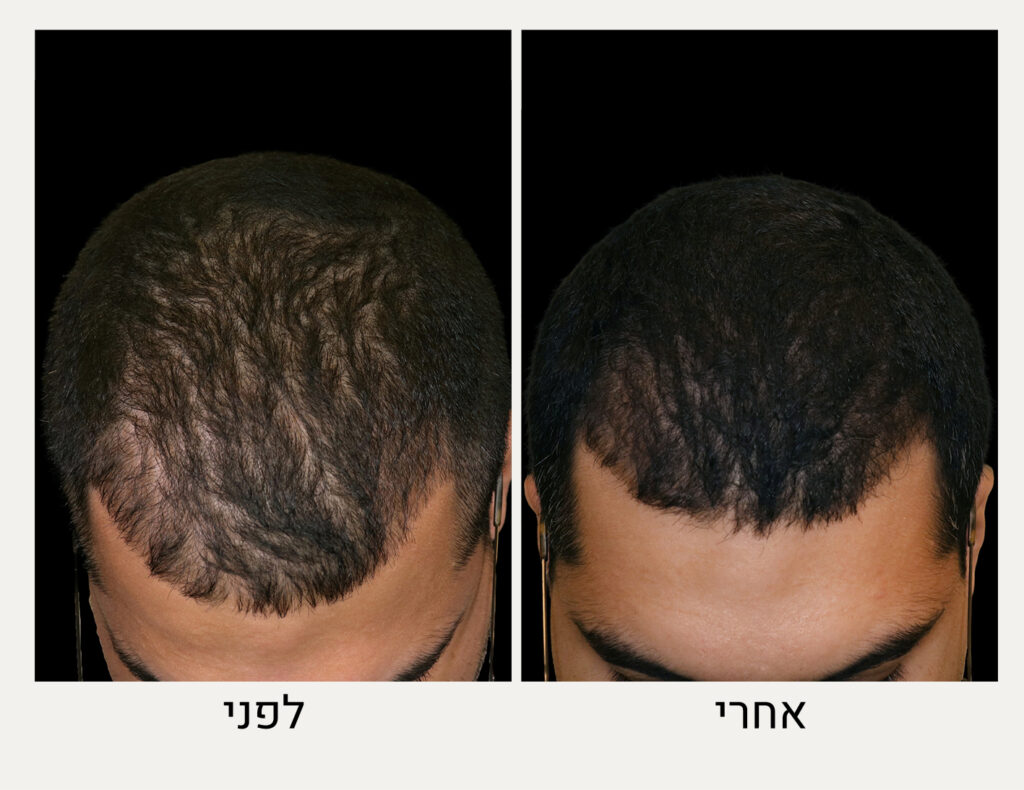 לפני ואחרי טיפול אקסוזומים לשיער