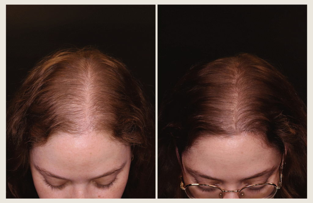 טיפול אקסוזומים לשיער לפני ואחרי - ד"ר אלה אגוזי