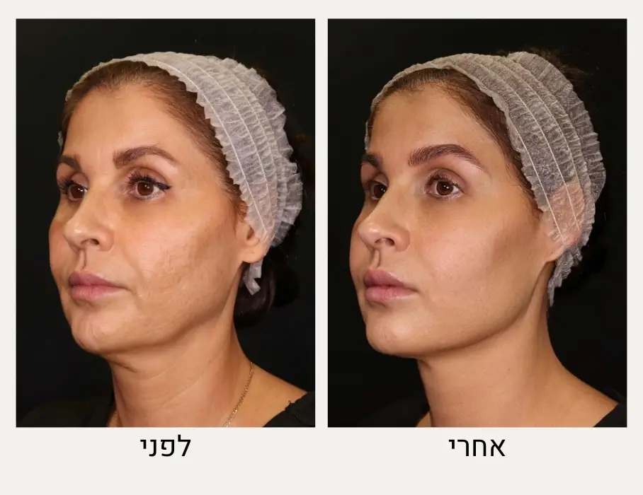 לפני ואחרי הזרקת שומן לפנים - המרכז לרפואת עור ואסתטיקה, ד"ר אלה אגוזי