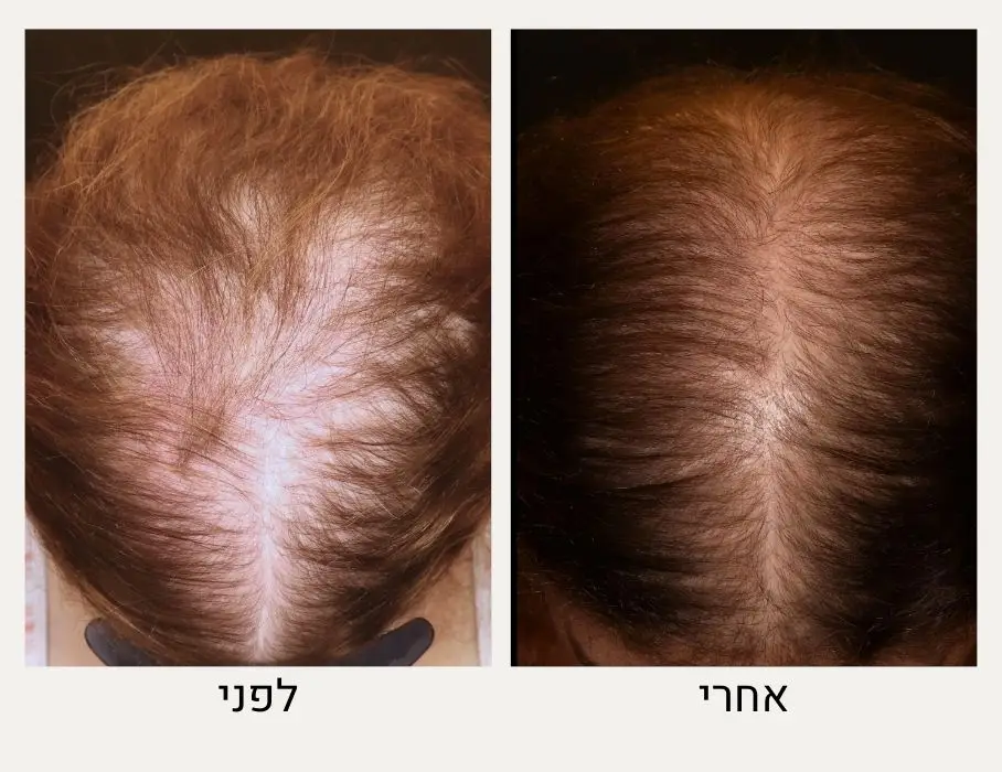 טיפול ריגנרה לשיער לפני ואחרי - ד"ר אלה אגוזי