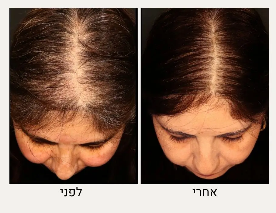 טיפול מזותרפיה לשיער לפני ואחרי - ד"ר אלה אגוזי