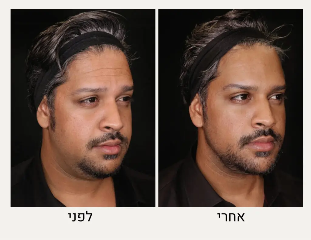 בוטוקס לגברים לפני ואחרי - ד"ר אלה אגוזי