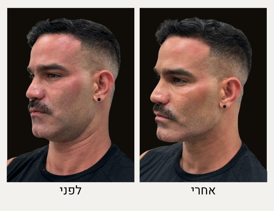 לפני ואחרי עיצוב קו לסת לגבר - ד"ר אלה אגוזי