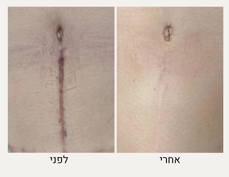 לפני ואחרי הסרת צלקות בלייזר - מרכז לרפואת עור ואסתטיקה בהנהלת ד״ר אלה אגוזי