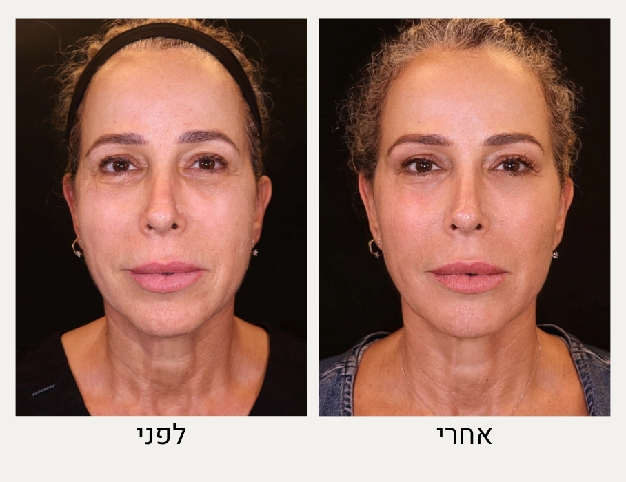פילינג לייזר לפני ואחרי - מרכז לרפואת עור ואסתטיקה בהנהלת ד״ר אלה אגוזי