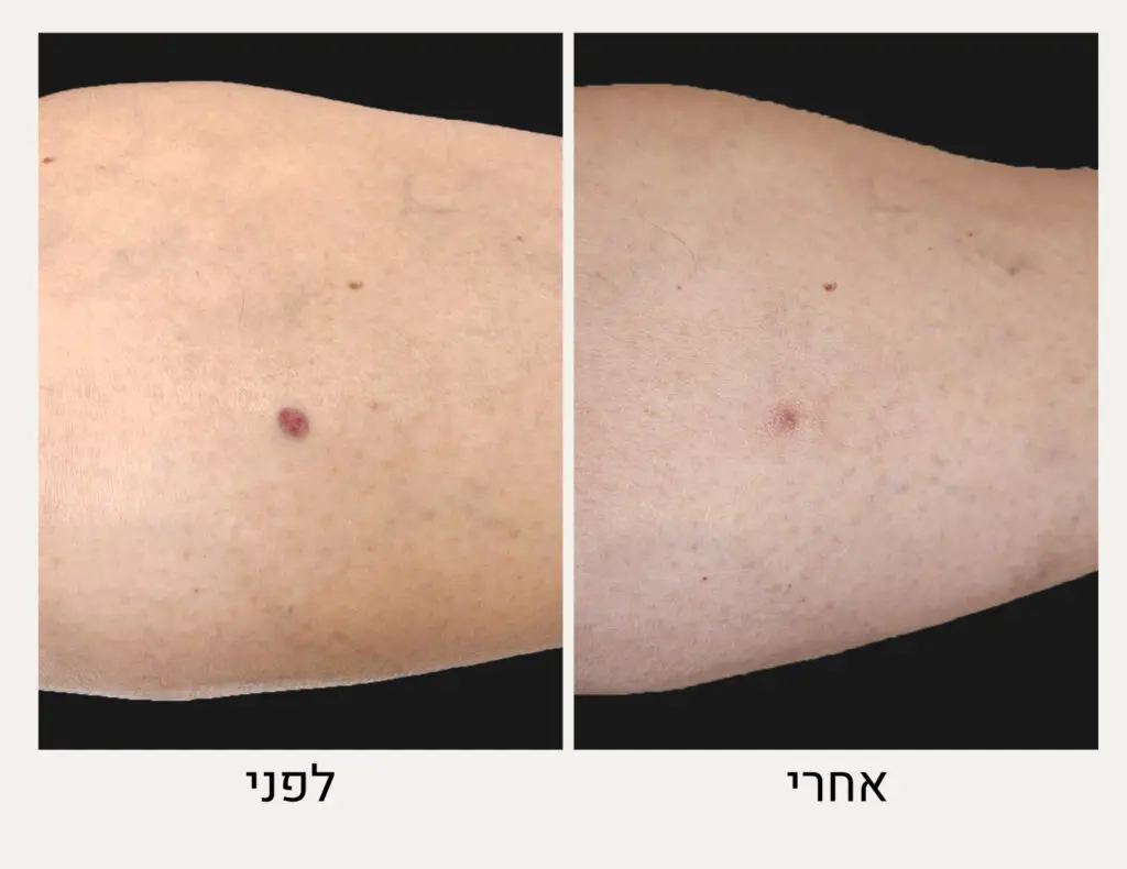 הסרת נקודות אדומות לפני ואחרי - המרכז לרפואת עור ואסתטיקה, ד״ר אלה אגוזי