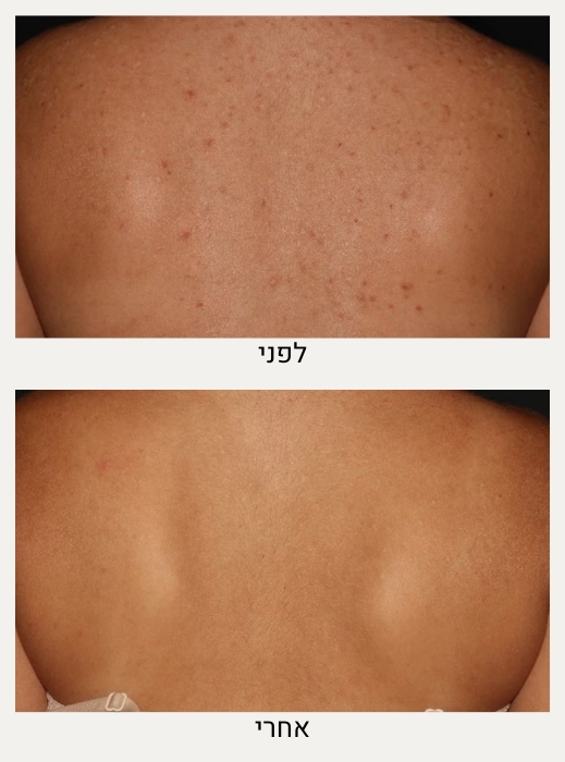 טיפול באקנה בגב ובישבן לפני ואחרי - ד״ר אלה אגוזי