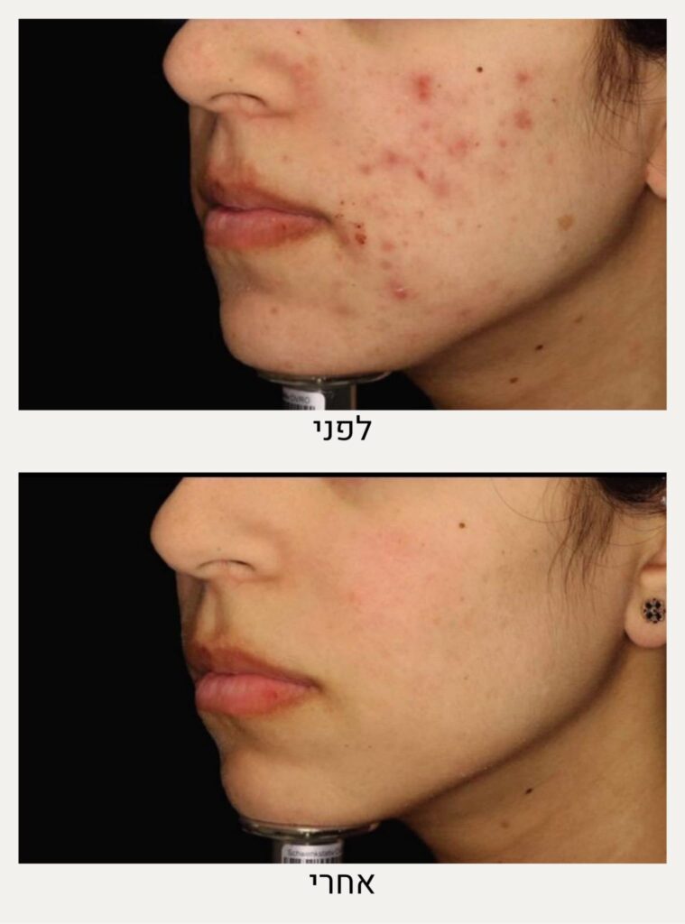 תמונות לפני ואחרי טיפול באקנה הורמונלי - ד״ר אלה אגוזי