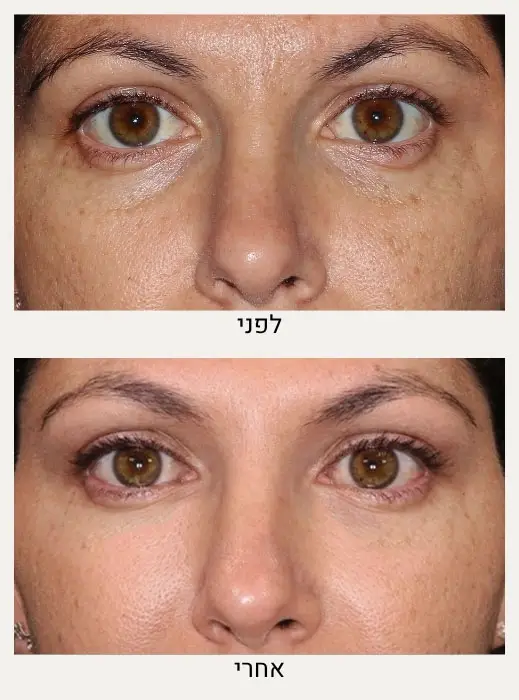 לפני ואחרי טיפול בשקיות מתחת לעיניים - מרכז לרפואת עור ואסתטיקה בהנהלת ד״ר אלה אגוזי