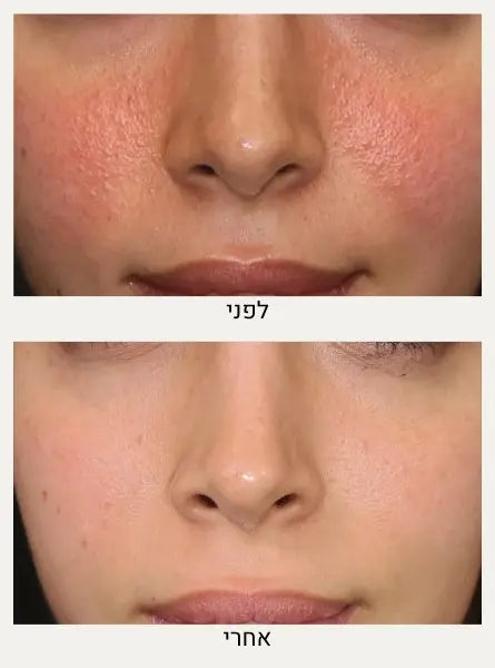 לפני ואחרי טיפול ברוזציאה - ד״ר אלה אגוזי