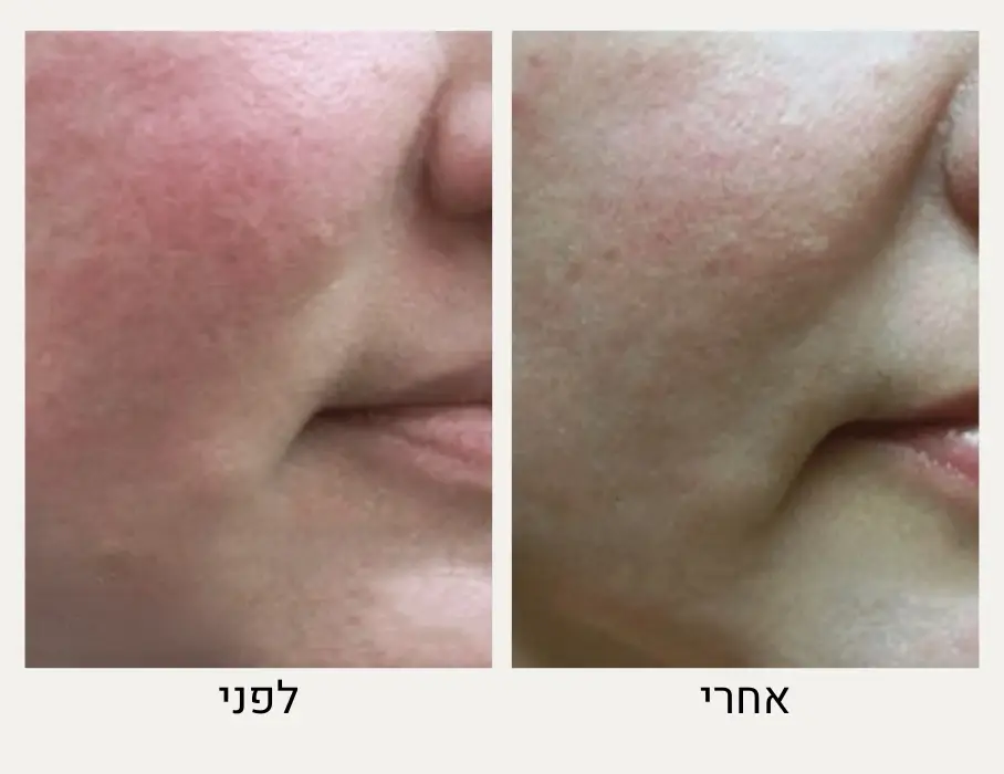 טיפול ברוזציאה לפני ואחרי - ד״ר אלה אגוזי