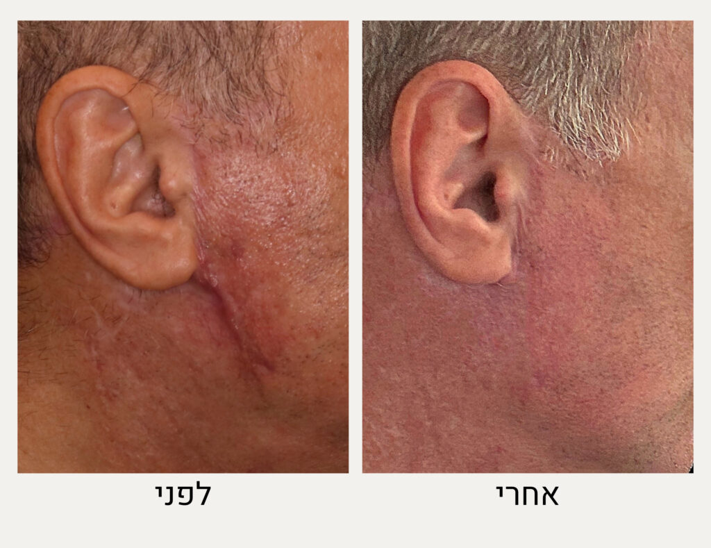 טיפול בצלקת קלואידית לפני ואחרי, ד"ר אלה אגוזי