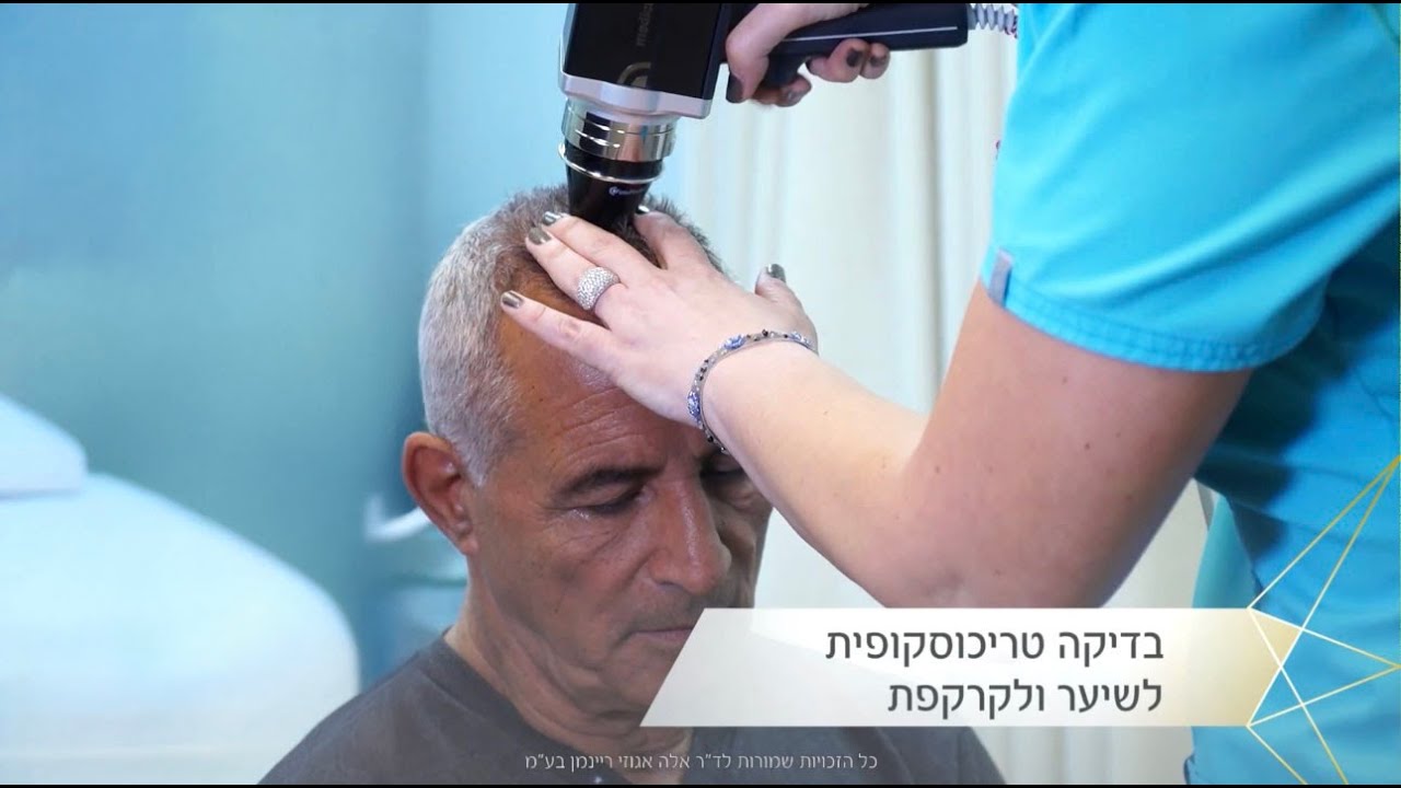 סרטון - טיפול בנשירת שיער גברים, ד"ר אלה אגוזי