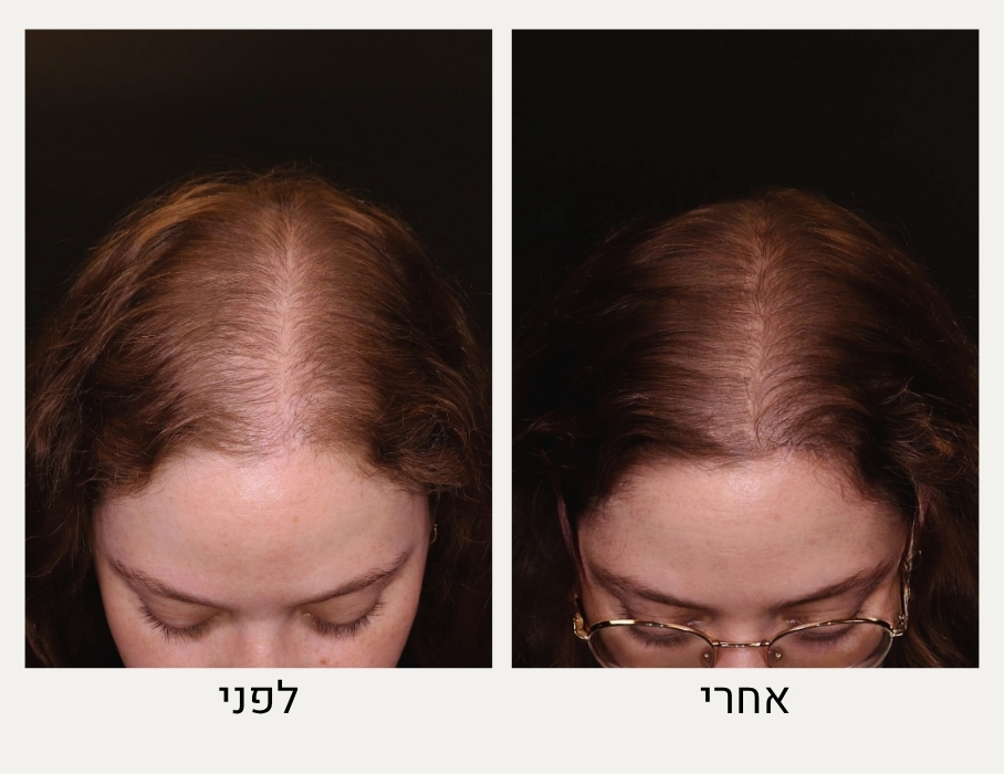 טיפול בנשירת שיער נשים לפני ואחרי - ד"ר אלה אגוזי