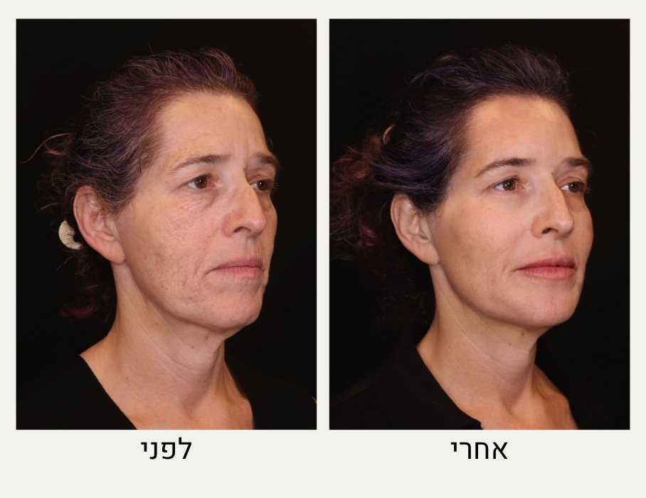 תמונות הרמת פנים ללא ניתוח - המרכז לרפואת עור ואסתטיקה, ד״ר אלה אגוזי