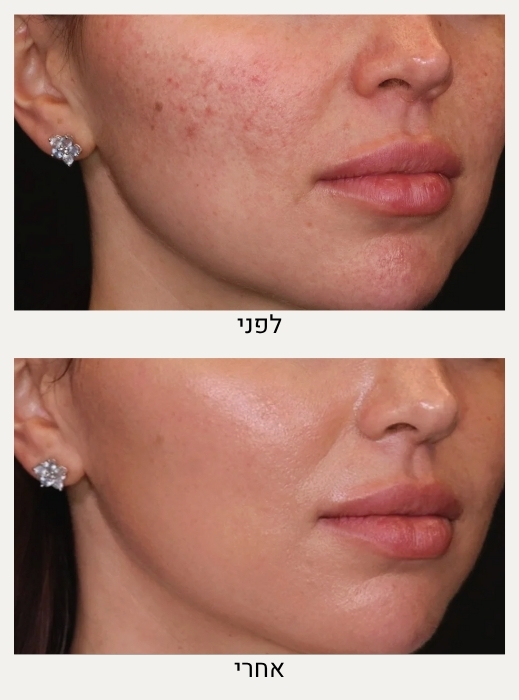 טיפול אקסוזומים לפנים לפני ואחרי - ד"ר אלה אגוזי