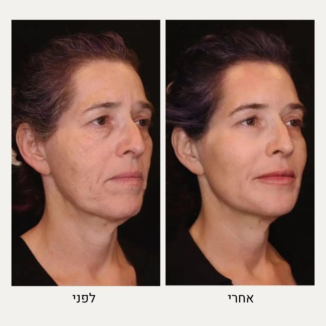 תמונות לפני ואחרי מתיחת פנים ללא ניתוח - ד״ר אלה אגוזי
