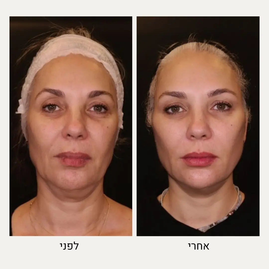 פיסול פנים לפני ואחרי - טיפול עור ואסתטיקה, ד"ר אלה אגוזי