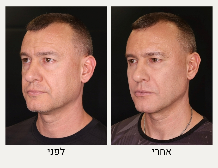 טיפולי אסתטיקה לגברים לפני ואחרי - ד