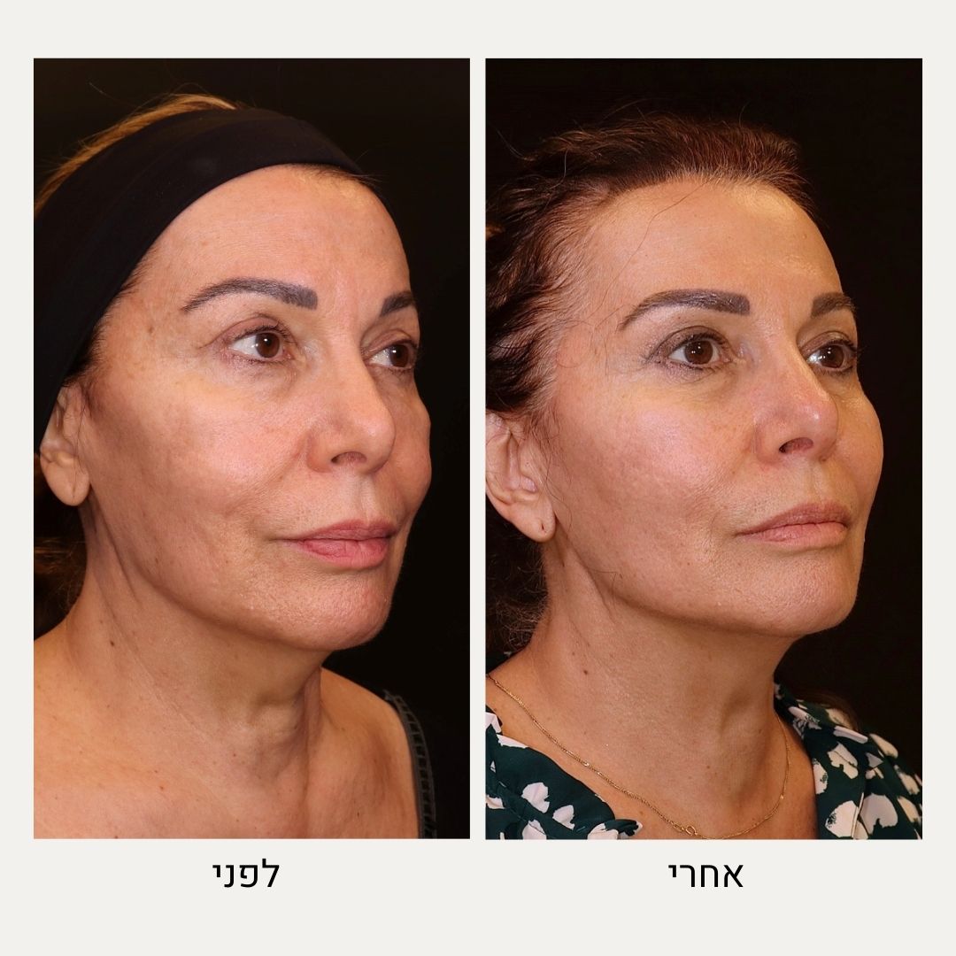 לפני ואחרי טיפול בשיטת שלושת השכבות - ד"ר אלה אגוזי