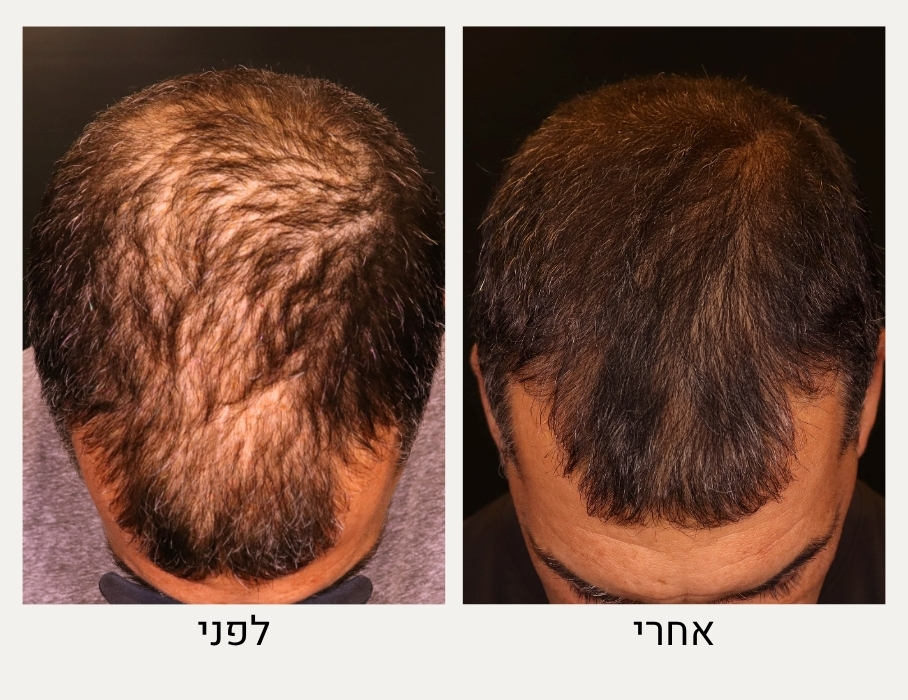 לפני ואחרי טיפול בנשירת שיער - ד״ר אלה אגוזי