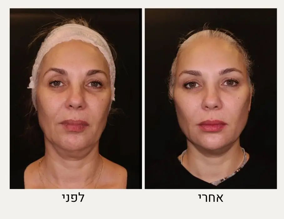 פיסול פנים לפני ואחרי - טיפול עור ואסתטיקה, ד