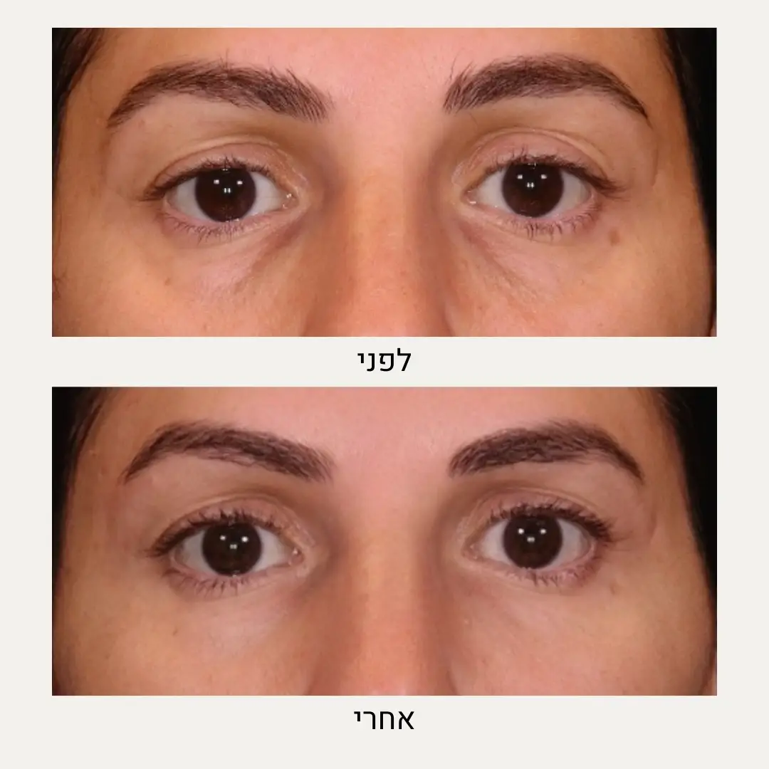 תמונות לפני ואחרי שקעי עיניים - ד״ר אלה אגוזי