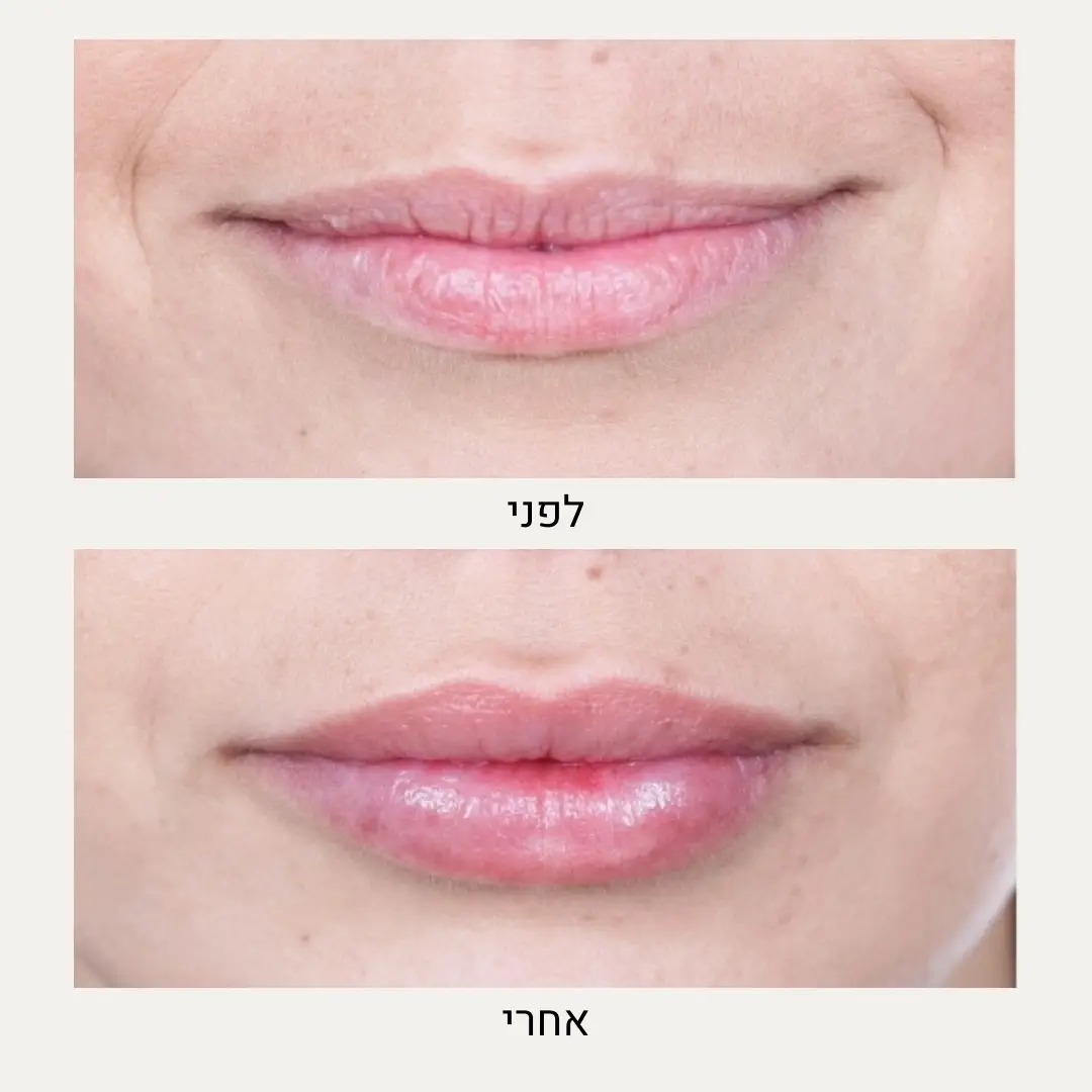 תמונות לפני ואחרי שפתיים - ד״ר אלה אגוזי