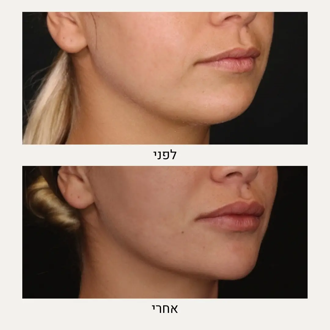 תמונות לפני ואחרי עיצוב סנטר - ד״ר אלה אגוזי